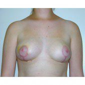 Breast Asymmetry 2