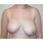 Breast Asymmetry 2