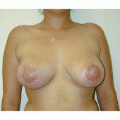 Breast Asymmetry 3