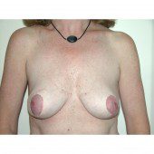 Breast Asymmetry 4