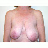 Breast Asymmetry 4