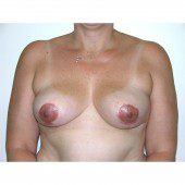 Breast Asymmetry 6