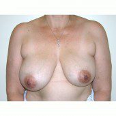 Breast Asymmetry 6