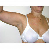 Breast Asymmetry 7