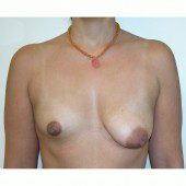 Breast Asymmetry 5