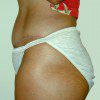 Abdominoplasty 7 After Photo Thumbnail