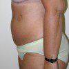 Abdominoplasty 33 After Photo Thumbnail