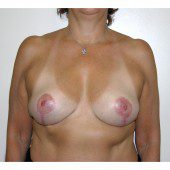 Breast Asymmetry 8