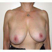 Breast Asymmetry 8