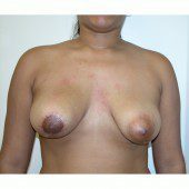 Breast Asymmetry 9