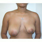 Breast Asymmetry 9