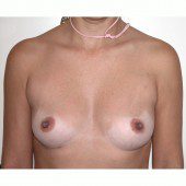 Breast Augmentation 33