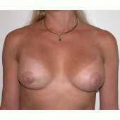 Breast Augmentation 32