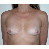 Breast Augmentation 32