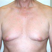 Gynaecomastia 1