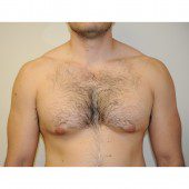 Gynaecomastia 2