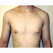 Gynaecomastia 3