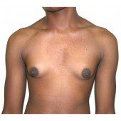 Gynaecomastia 4