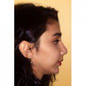 Rhinoplasty 902