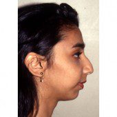 Rhinoplasty 902