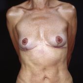 Breast Revision 2