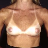 Breast Augmentation 38