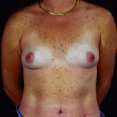 Breast Augmentation 39