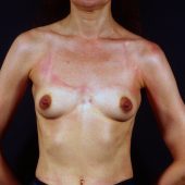 Breast Revision 6