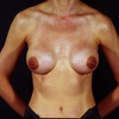 Breast Revision 6