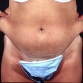 Liposuction Abdomen 1