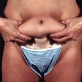 Liposuction Abdomen 1