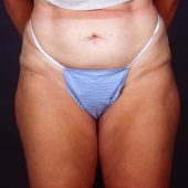 Liposuction 1x