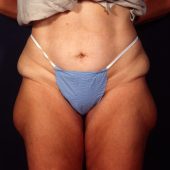 Liposuction 1x