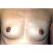 Prepectoral Breast Augmentation