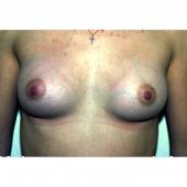 Prepectoral Breast Augmentation