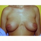 Prepectoral Breast Augmentation 3