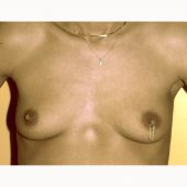 Prepectoral Breast Augmentation 3