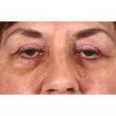 Blepharoplasty 231