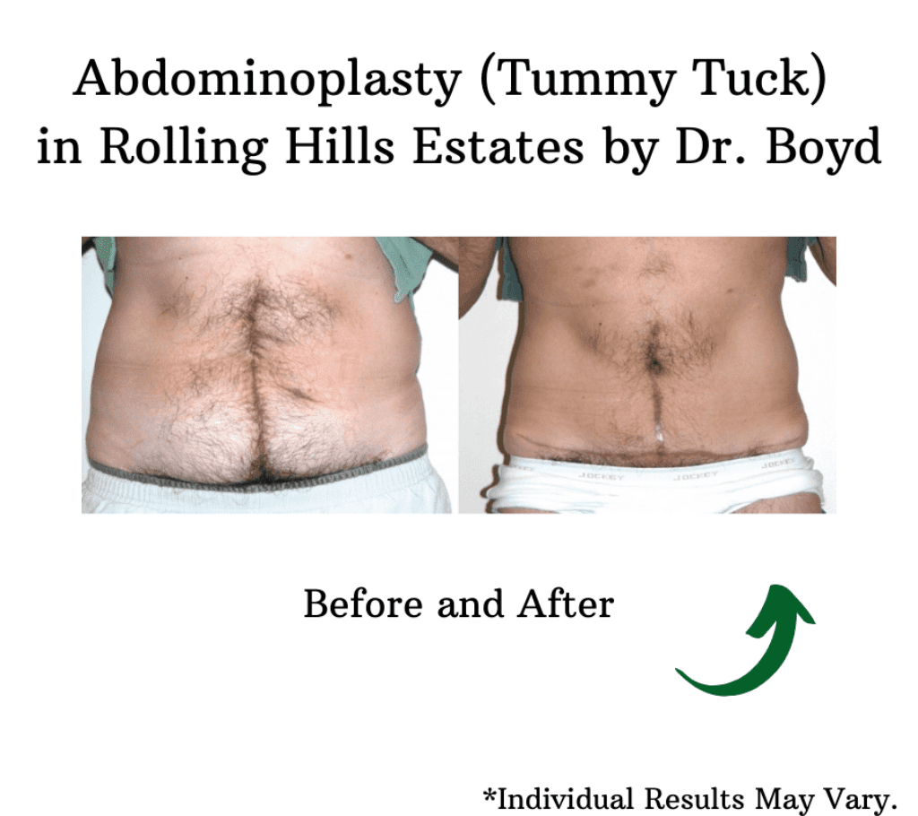 What are The Differences Between a Liposuction and Tummy Tuck